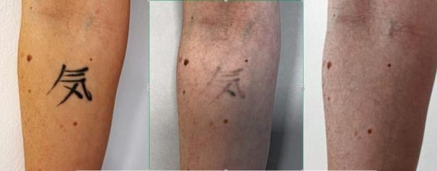 Laser-Tattooentfernung in drei Stufen: Die Tätowierung eines chinesischen Schriftzeichens auf einem Unterarm, das nur noch leicht sichtbare Schriftzeichen nach 8 Laserbehandlungen und vollständig entfernt nach 12.