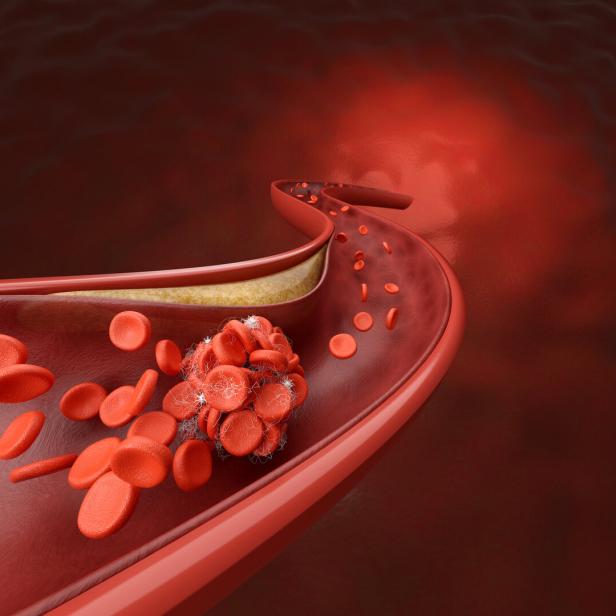 coronary artery and blood clot